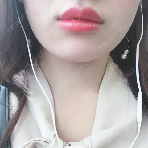 ヒアルロン酸注入（唇） ルラ美容クリニック 高田馬場院 AFTER