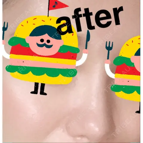 ヒアルロン酸注入（鼻） メディカルプラスクリニック新宿 AFTER