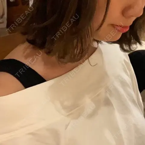その他（輪郭） 水の森美容クリニック 大阪院 AFTER