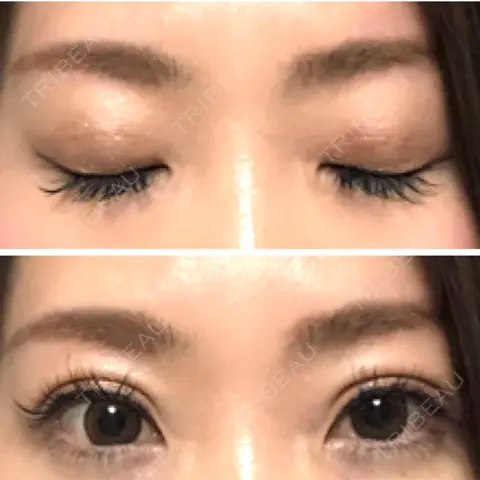 二重埋没 大阪TAクリニック AFTER