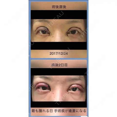 二重切開 / 目頭切開 品川美容外科 千葉院 DAY 0