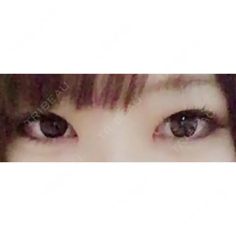 目頭切開 表参道ヘレネクリニック AFTER