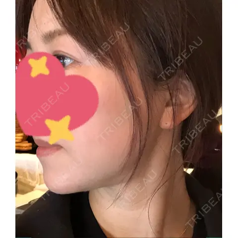 糸リフト / ボトックス（あご） / ヒアルロン酸注入（あご） 湘南美容クリニック 札幌院 AFTER