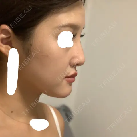 ヒアルロン酸注入（鼻） BIANCA銀座 DAY 0