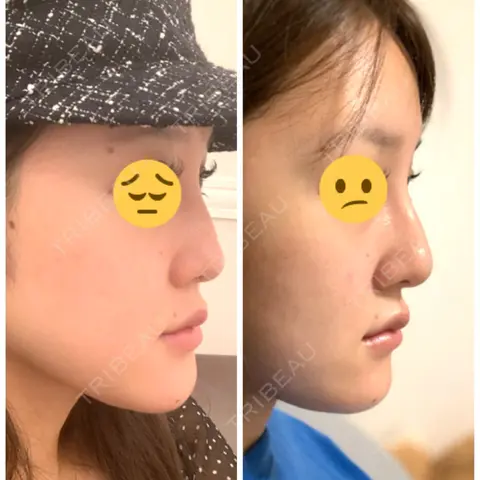 ヒアルロン酸注入（鼻） BIANCA銀座 AFTER