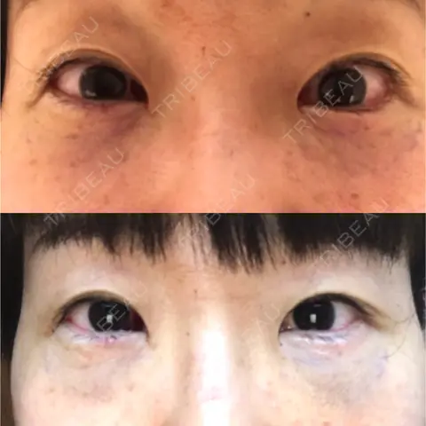 下まぶたの脂肪取り KOBE美容皮膚科 西宮院 DAY 0