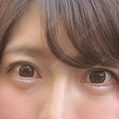 ヒアルロン酸注入（涙袋） 銀座国際美容外科 池袋院 AFTER