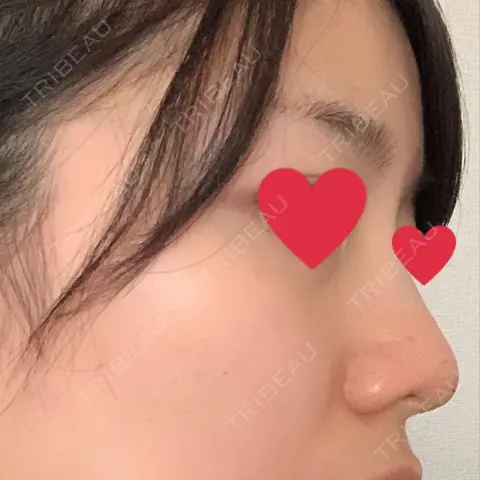 鼻中隔延長（切開） 湘南美容クリニック 新潟院 DAY 0