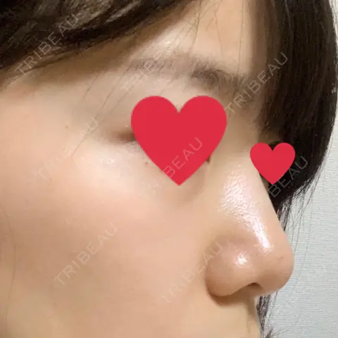 鼻中隔延長（切開） 湘南美容クリニック 新潟院 AFTER
