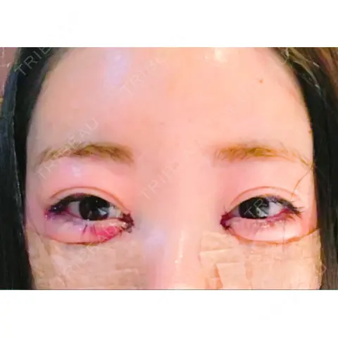 目頭切開 / 目尻切開 / 下まぶたの脂肪取り / 脂肪注入（肌） / ヒアルロン酸注入（涙袋） プロミス整形外科 DAY 0