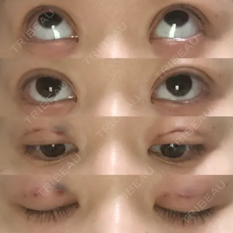二重埋没 THE MEDICAL SALON DAY 0