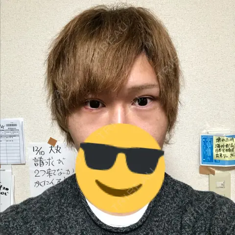 ヒアルロン酸注入（涙袋） abijouクリニック DAY 2
