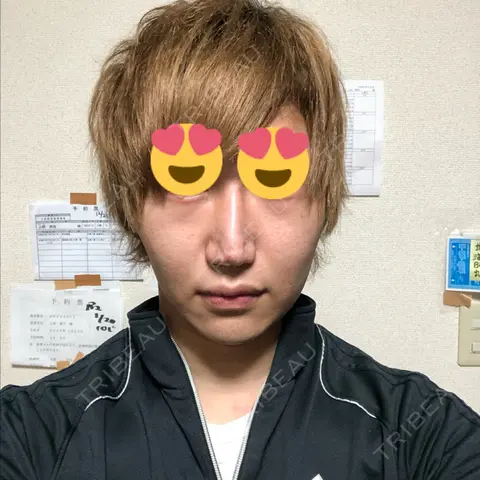 脂肪溶解注射（顔） abijouクリニック DAY 6