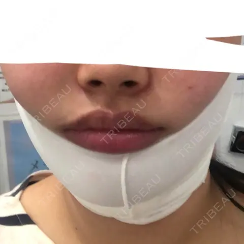 脂肪吸引（顔） 湘南美容クリニック 大阪心斎橋院 DAY 0