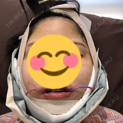 骨削り（エラ） / 骨削り（頬） / 脂肪吸引（顔） View美容整形外科 DAY 0