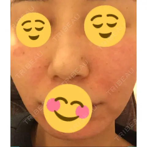 水光注射（ハリ・美肌） 銀座国際美容外科 池袋院 DAY 0