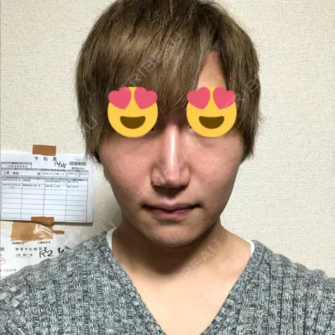 脂肪溶解注射（顔） abijouクリニック AFTER