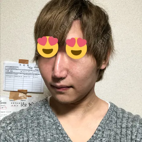 脂肪溶解注射（顔） abijouクリニック AFTER