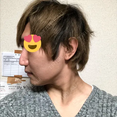脂肪溶解注射（顔） abijouクリニック AFTER
