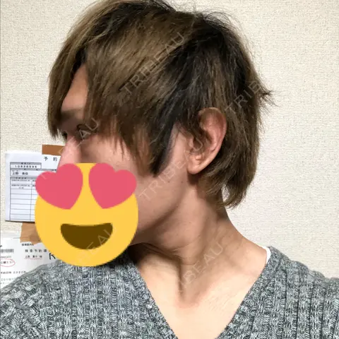 ヒアルロン酸注入（涙袋） abijouクリニック AFTER