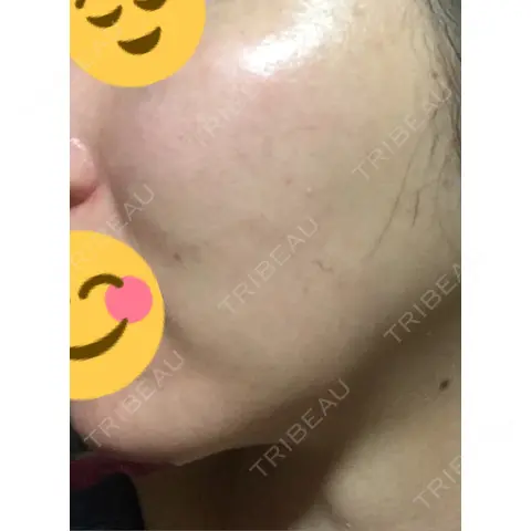 水光注射（ハリ・美肌） 銀座国際美容外科 池袋院 AFTER