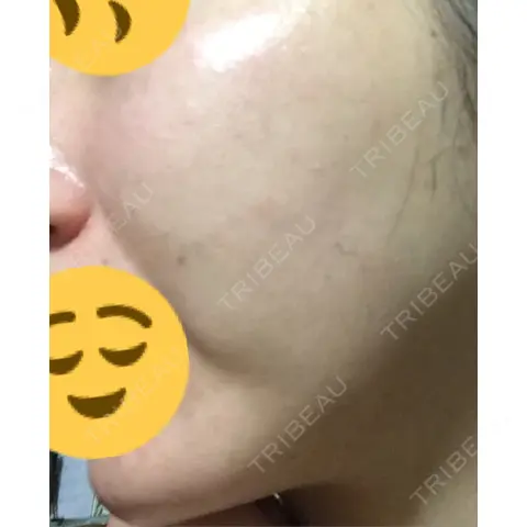 水光注射（ハリ・美肌） 銀座国際美容外科 池袋院 AFTER