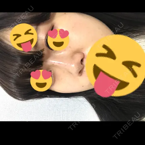 ヒアルロン酸注入（鼻） 恵聖会クリニック 心斎橋院 DAY 0