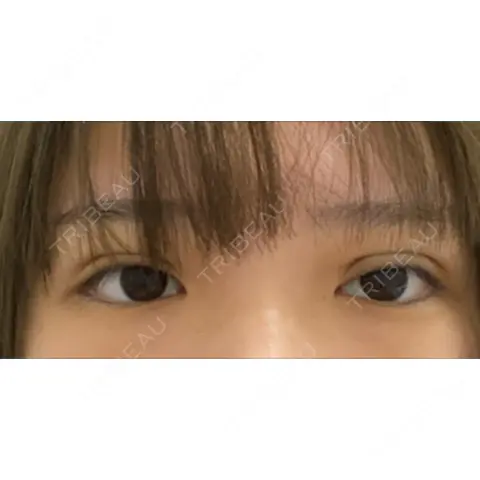 二重埋没 共立美容外科 熊本院 DAY 0