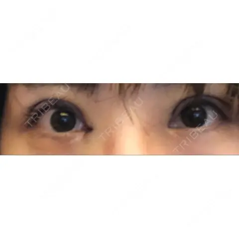 二重切開 / 目頭切開 / 眼瞼下垂（切開） こいずみ形成クリニック名古屋 DAY 0
