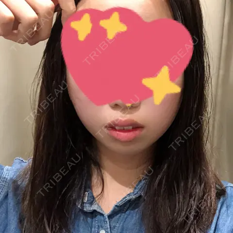 糸リフト / バッカルファット除去 湘南美容クリニック 大阪京橋院 DAY 0