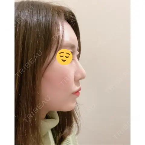 隆鼻術 / 軟骨移植 / プロテーゼ除去 エイト美容外科 AFTER