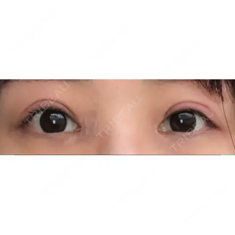二重切開 / 目頭切開 / 眼瞼下垂（切開） こいずみ形成クリニック名古屋 AFTER