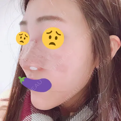 隆鼻術 / 鼻尖形成（切開） / 鼻修正 / 鼻尖縮小 / 鼻翼基部形成（貴族手術） サラ美容外科 DAY 0