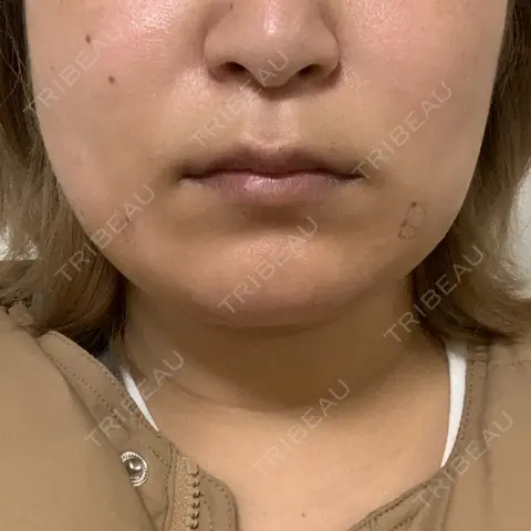 糸リフト / 脂肪溶解注射（顔） 品川スキンクリニック 新潟院 DAY 0
