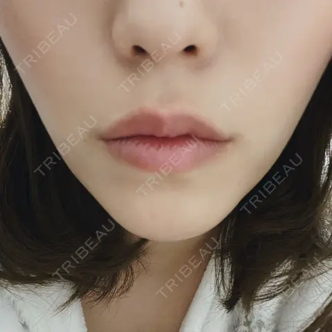 ボトックス（エラ・小顔） 湘南美容クリニック 新宿本院 DAY 0