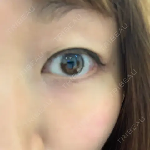 ヒアルロン酸溶解 湘南美容クリニック 大阪京橋院 DAY 0