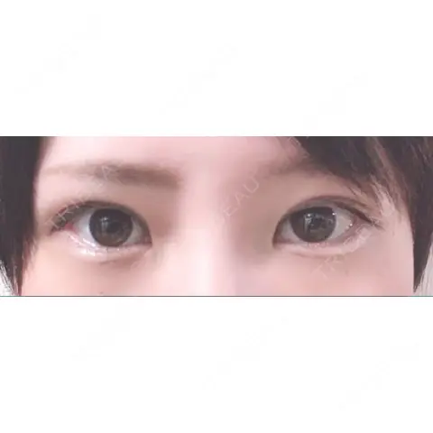 二重埋没 / 脂肪吸引（顔） / ボトックス（エラ・小顔） 藤・ナチュレ美容クリニック 恵比寿院 AFTER