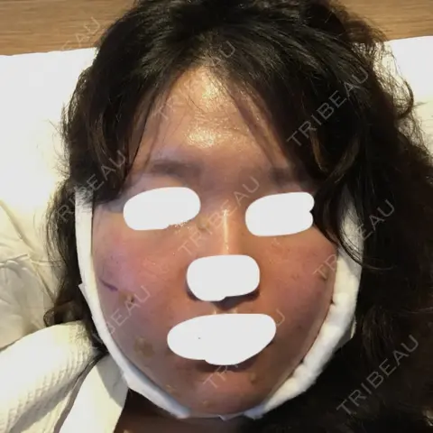 骨削り（頬） TL美容整形外科 顔面輪郭・目・鼻センター DAY 0
