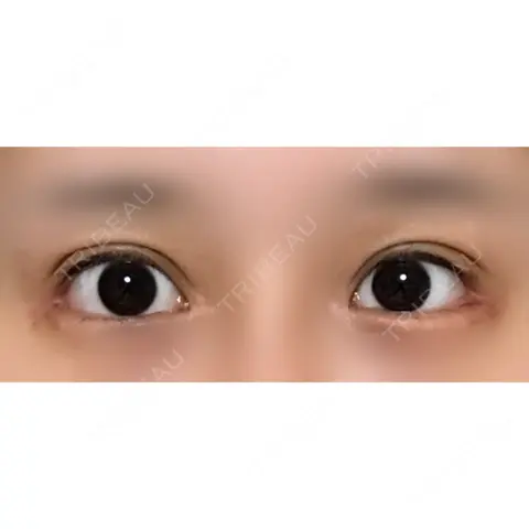 目尻切開 / 目尻靭帯移動 VARABON美容外科 AFTER