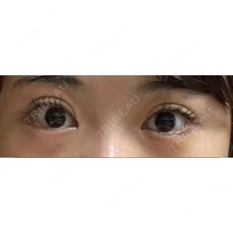 目頭切開 / 眼瞼下垂（切開） / 目尻切開 / タレ目形成・グラマラスライン（切開） / 目元修正 / 目尻靭帯移動 DIVINE（ディバイン）整形外科 AFTER
