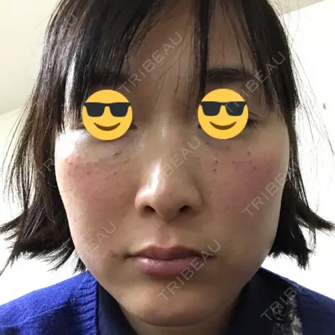 水光注射（ハリ・美肌） 銀座国際美容外科 池袋院 DAY 0