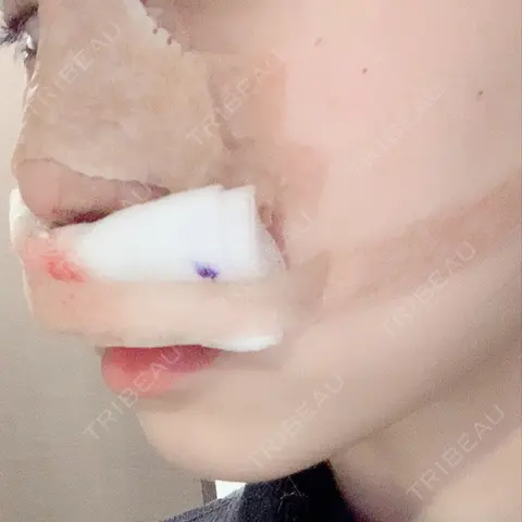 隆鼻術 / 軟骨移植 / ワシ鼻修正・ハンプ切除 / 鼻翼基部形成（貴族手術） / その他（目元） NANA（ナナ）美容外科 DAY 0