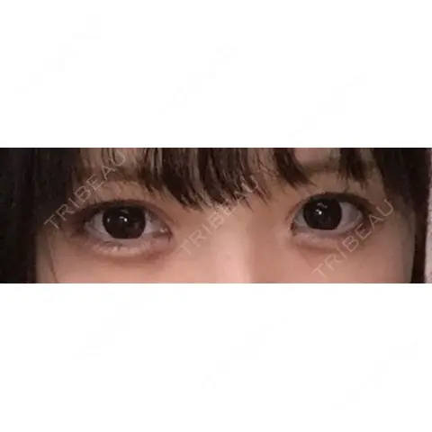 二重埋没 / 目頭切開 品川美容外科 千葉院 DAY 395