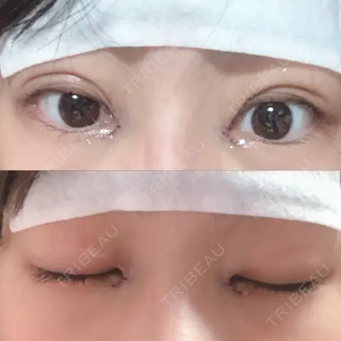 二重埋没 / 目頭切開 アロマ美容外科クリニック DAY 0