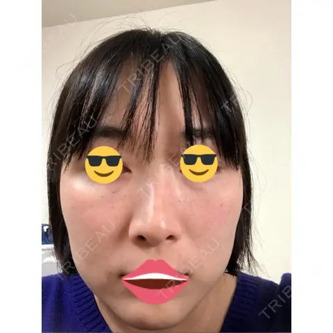 水光注射（ハリ・美肌） 銀座国際美容外科 池袋院 AFTER