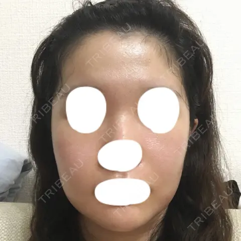 骨削り（頬） TL美容整形外科 顔面輪郭・目・鼻センター AFTER