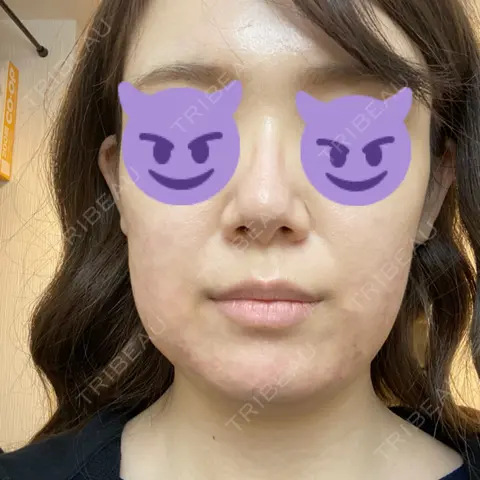 脂肪溶解注射（顔） 湘南美容クリニック 西宮北口院 DAY 0