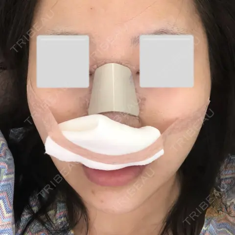 隆鼻術 / 鼻尖形成（切開） / 鼻中隔延長（切開） / 小鼻縮小（切開） / 軟骨移植 / 骨切幅寄せ / ワシ鼻修正・ハンプ切除 / 鼻修正 View美容整形外科 DAY 0