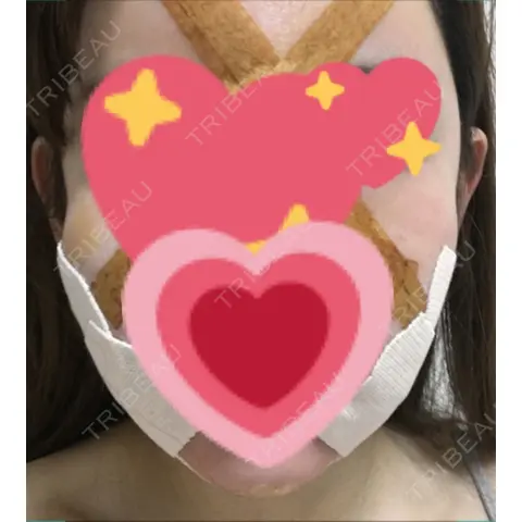 脂肪吸引（顔） / ヒアルロン酸注入（あご） / ボトックス（エラ・小顔） エートップ美容整形外科 DAY 0