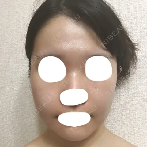 骨削り（頬） TL美容整形外科 顔面輪郭・目・鼻センター AFTER